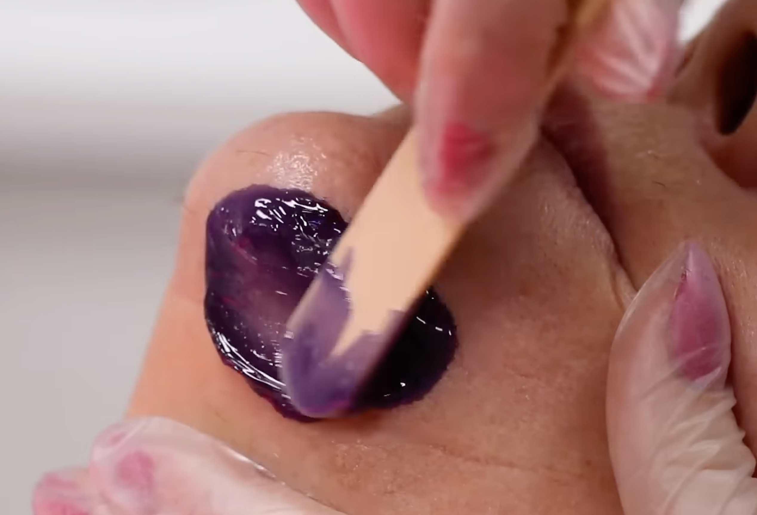 LYCOjet Hot Wax being applied on chin